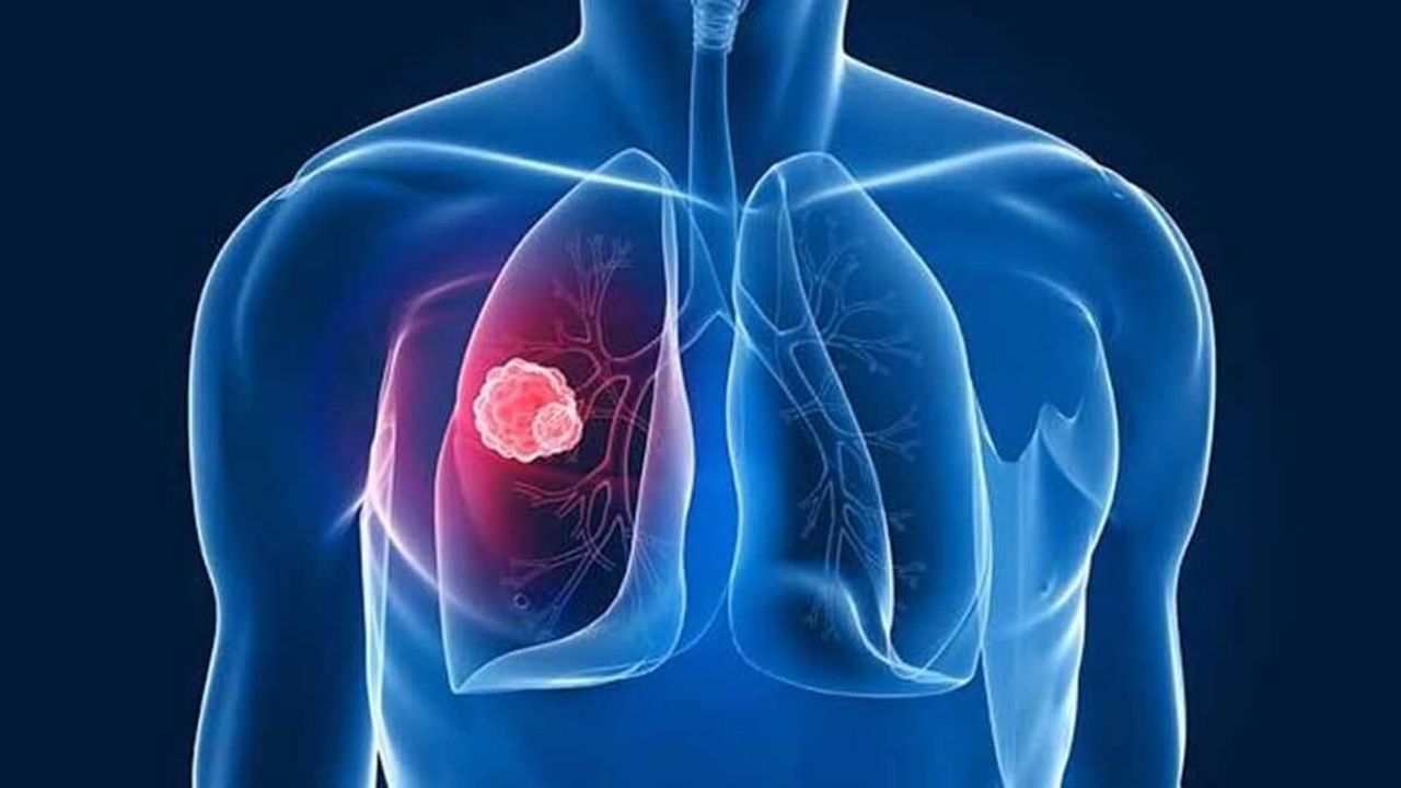 Akciğer enfeksiyonu nedir? Akciğer enfeksiyonunun en yaygın belirtileri!